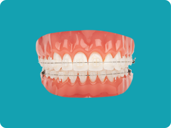 Clear Braces