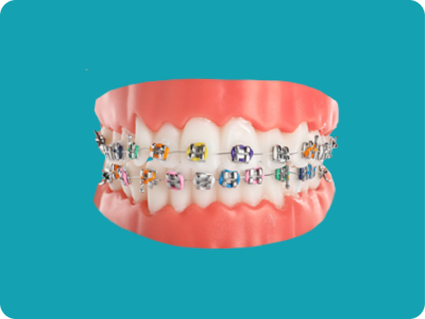 Metal Braces