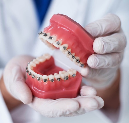Braces in Brevard County