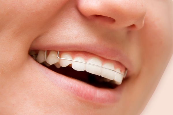 What is a retainer