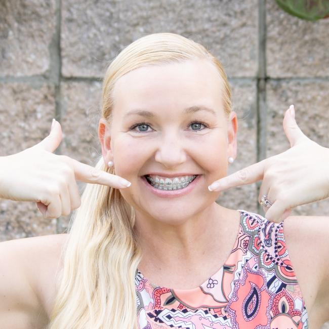 Braces in Brevard County